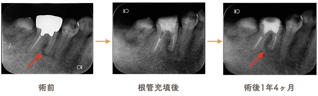 木更津市　感染根管治療　術前・根管充填後・術後1年4ヶ月